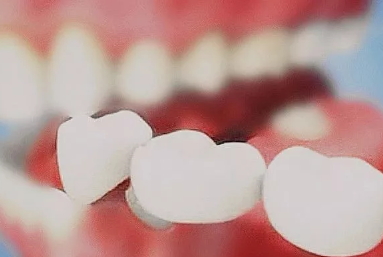 美容冠多少錢一顆？美容冠矯正費(fèi)用