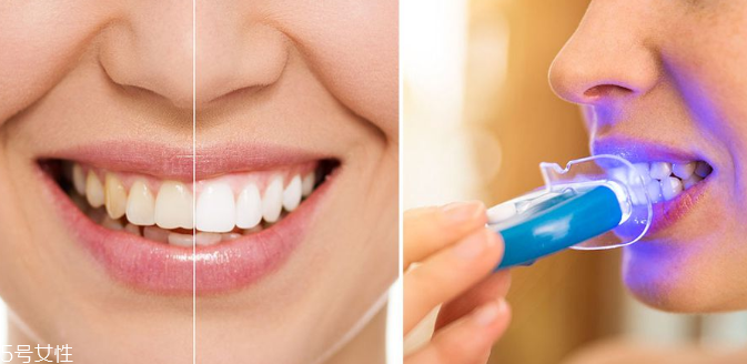 牙齒美白能保持多久？牙齒美白方法有哪些？