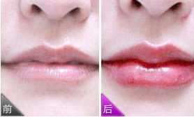 紋唇多少錢？紋唇風險大嗎