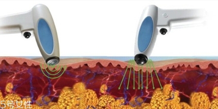 射頻溶脂效果怎么樣？射頻溶脂風險大嗎
