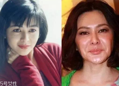 顴骨墊高手術(shù)風(fēng)險(xiǎn)大嗎 顴骨墊高會(huì)不會(huì)失敗