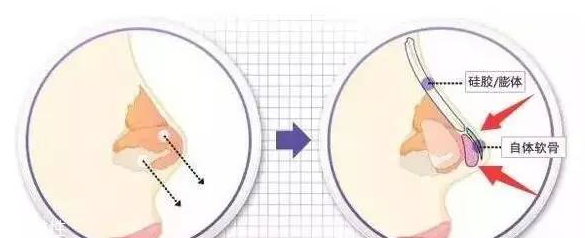 墊鼻尖需要多少錢 墊鼻尖手術(shù)價格高嗎 墊鼻尖需要多少錢 墊鼻尖手術(shù)價格高嗎