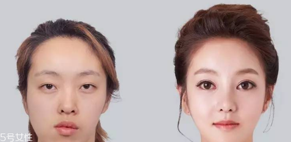 墊鼻尖需要多少錢 墊鼻尖手術(shù)價格高嗎 墊鼻尖需要多少錢 墊鼻尖手術(shù)價格高嗎