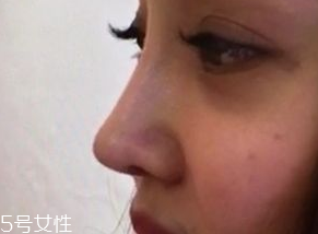 墊鼻尖后多久能做運動 墊鼻尖后做運動要注意什么 墊鼻尖后多久能做運動 墊鼻尖后做運動要注意什么