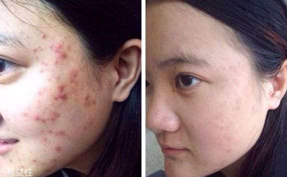 祛痘手術有哪些 4種祛痘手術哪種最好