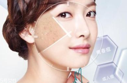 祛痘手術有哪些 4種祛痘手術哪種最好