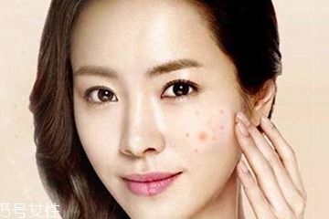 祛痘手術(shù)需要多少錢 祛痘手術(shù)費(fèi)用很高嗎