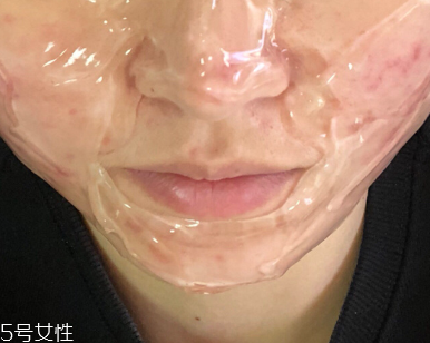 紅藍(lán)光治痤瘡需要幾次 紅藍(lán)光治痤瘡幾個(gè)療程能痊愈 紅藍(lán)光治痤瘡需要幾次 紅藍(lán)光治痤瘡幾個(gè)療程能痊愈