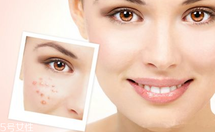 紅藍(lán)光治痤瘡需要幾次 紅藍(lán)光治痤瘡幾個(gè)療程能痊愈 紅藍(lán)光治痤瘡需要幾次 紅藍(lán)光治痤瘡幾個(gè)療程能痊愈