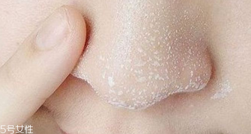 黑頭不管它會(huì)變大嗎？黑頭不管它會(huì)怎樣？