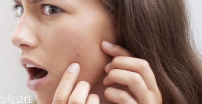 頑固痘痘怎么消除？油皮為什么反復(fù)爆痘？