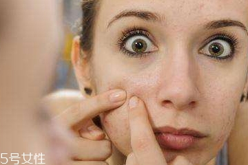 頑固痘痘怎么消除？油皮為什么反復(fù)爆痘？