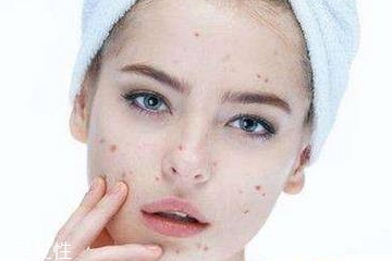 長了粉刺可以擠掉嗎 這樣做粉刺要加重 長了粉刺可以擠掉嗎 這樣做粉刺要加重