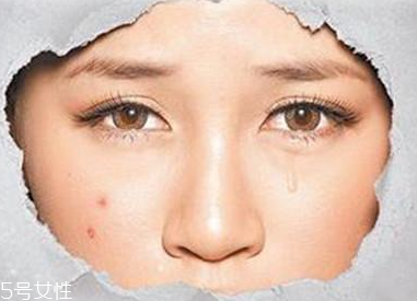 長了粉刺可以擠掉嗎 這樣做粉刺要加重 長了粉刺可以擠掉嗎 這樣做粉刺要加重