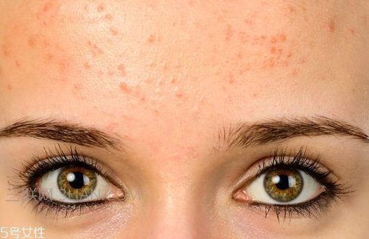 長了粉刺可以擠掉嗎 這樣做粉刺要加重 長了粉刺可以擠掉嗎 這樣做粉刺要加重