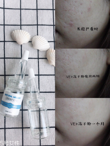 凍干粉怎么用效果最好 如何拯救痘痘肌 凍干粉怎么用效果最好 如何拯救痘痘肌