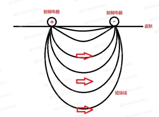 射頻美容儀原理是什么 皮薄敏感肌不適合用 射頻美容儀原理是什么 皮薄敏感肌不適合用