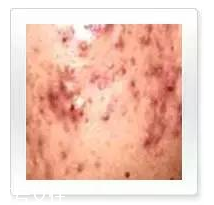 平衡露什么成分能祛痘 強效抑制痘痘生長 平衡露什么成分能祛痘 強效抑制痘痘生長