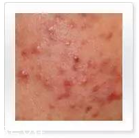 平衡露什么成分能祛痘 強效抑制痘痘生長 平衡露什么成分能祛痘 強效抑制痘痘生長