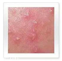 平衡露什么成分能祛痘 強效抑制痘痘生長 平衡露什么成分能祛痘 強效抑制痘痘生長