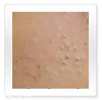 平衡露什么成分能祛痘 強效抑制痘痘生長 平衡露什么成分能祛痘 強效抑制痘痘生長