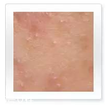 平衡露什么成分能祛痘 強效抑制痘痘生長 平衡露什么成分能祛痘 強效抑制痘痘生長