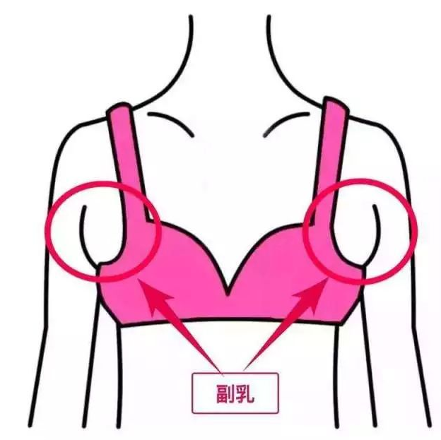 假副乳怎么形成的 3個(gè)不良習(xí)慣 假副乳怎么形成的 3個(gè)不良習(xí)慣