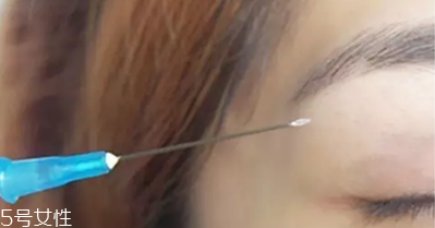 納米無痕雙眼皮是埋線嗎 納米無痕雙眼皮介紹 納米無痕雙眼皮是埋線嗎 納米無痕雙眼皮介紹