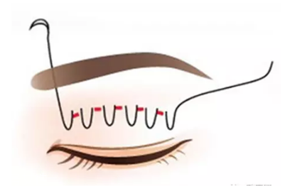 納米無痕雙眼皮是埋線嗎 納米無痕雙眼皮介紹 納米無痕雙眼皮是埋線嗎 納米無痕雙眼皮介紹