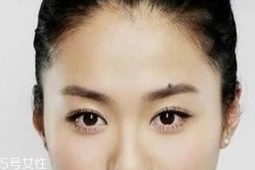 點(diǎn)痣是掛什么科 這個(gè)科室才對(duì) 點(diǎn)痣是掛什么科 這個(gè)科室才對(duì)