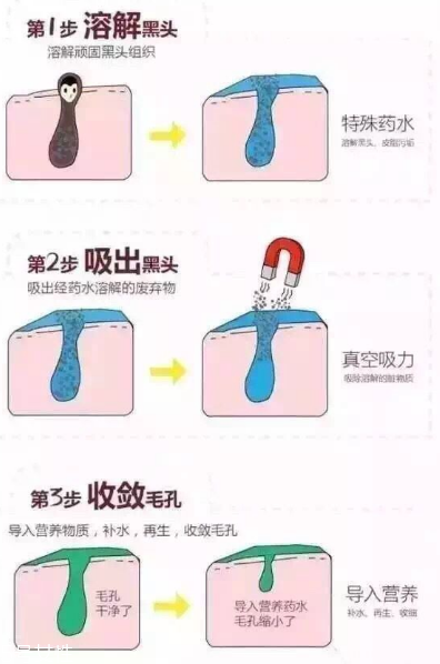 小氣泡孕婦可以做嗎 一般不建議 小氣泡孕婦可以做嗎 一般不建議