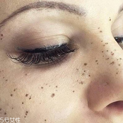 皮秒能去痘印嗎 去痘印是小意思 皮秒能去痘印嗎 去痘印是小意思