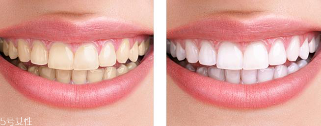 佳潔士美白牙貼有害嗎 不會(huì)傷害到牙釉質(zhì) 佳潔士美白牙貼有害嗎 不會(huì)傷害到牙釉質(zhì)