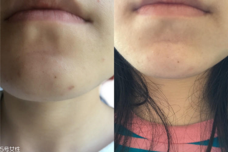 百膚美除疤效果怎么樣 和新疤舊印說(shuō)再見