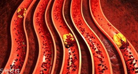 怎樣讓血管更年輕 只需要做到三步就行了 怎樣讓血管更年輕 只需要做到三步就行了