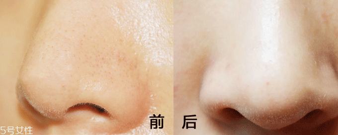 面膜什么成分能清潔毛孔 高嶺土能深層清潔 面膜什么成分能清潔毛孔 高嶺土能深層清潔