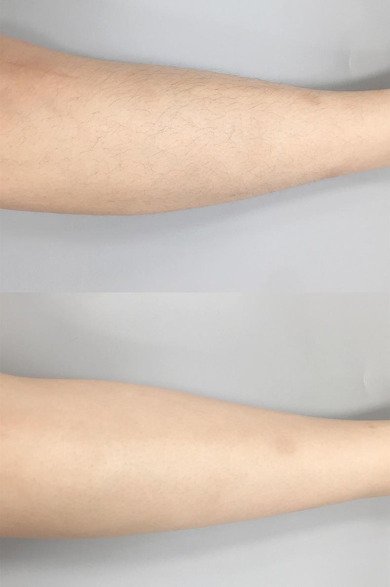 飛利浦脫毛儀怎么用 手把手教你怎么脫毛 飛利浦脫毛儀怎么用 手把手教你怎么脫毛