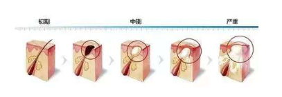 紅腫痘痘怎么快速消腫 遠(yuǎn)離紅腫痘痘大作戰(zhàn) 紅腫痘痘怎么快速消腫 遠(yuǎn)離紅腫痘痘大作戰(zhàn)