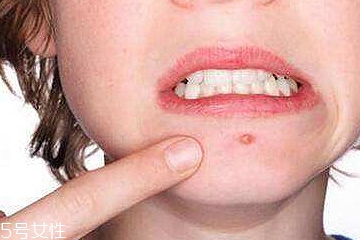 紅腫痘痘怎么快速消腫 遠(yuǎn)離紅腫痘痘大作戰(zhàn) 紅腫痘痘怎么快速消腫 遠(yuǎn)離紅腫痘痘大作戰(zhàn)