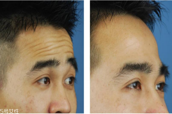 抬頭紋怎么去除？小妙招教給你