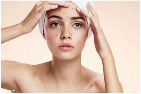 哪種痘痘不可以擠 擠痘痘的正確方法 哪種痘痘不可以擠 擠痘痘的正確方法