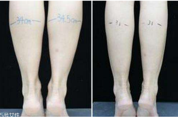 小腿吸脂后遺癥你知道多少？