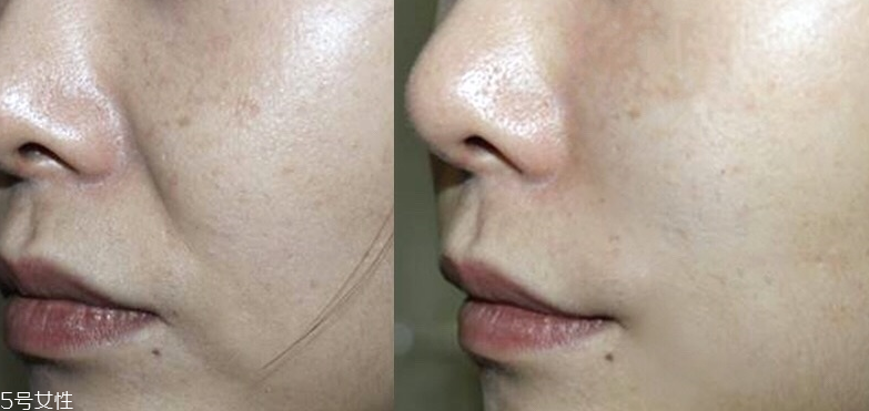 微針眼膜能天天使用嗎 一個禮拜用一次 微針眼膜能天天使用嗎 一個禮拜用一次