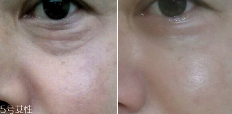 微針眼膜能天天使用嗎 一個禮拜用一次 微針眼膜能天天使用嗎 一個禮拜用一次