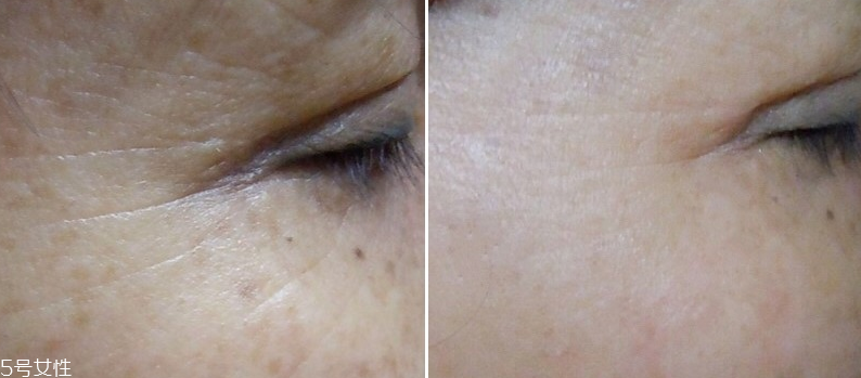 微針眼膜能天天使用嗎 一個禮拜用一次 微針眼膜能天天使用嗎 一個禮拜用一次