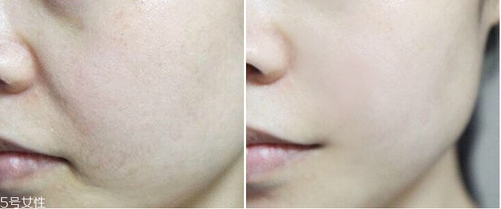 微針眼膜能天天使用嗎 一個禮拜用一次 微針眼膜能天天使用嗎 一個禮拜用一次