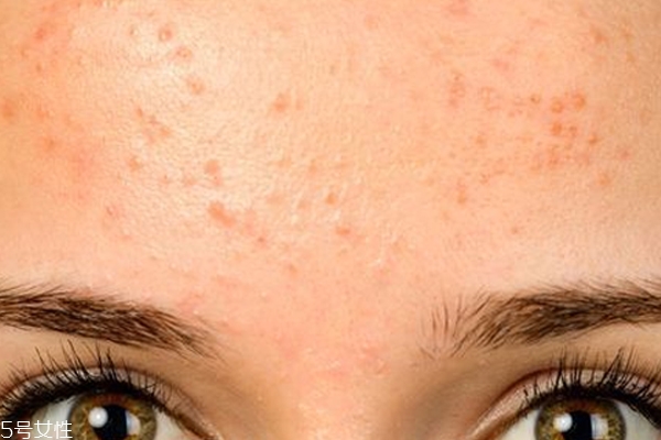 額頭大量冒痘什么原因 綠豆紅棗蓮藕能瀉火 額頭大量冒痘什么原因 綠豆紅棗蓮藕能瀉火