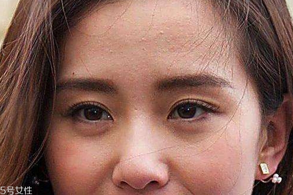痘痘位置代表哪里不健康 嘴角好長月經(jīng)痘 痘痘位置代表哪里不健康 嘴角好長月經(jīng)痘