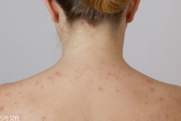 痘痘位置代表哪里不健康 嘴角好長月經(jīng)痘 痘痘位置代表哪里不健康 嘴角好長月經(jīng)痘