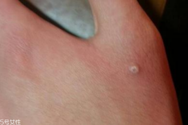 手上長了個硬疙瘩怎么回事 手上長了個硬疙瘩像繭 手上長了個硬疙瘩怎么回事 手上長了個硬疙瘩像繭